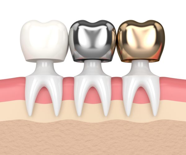 Pros And Cons Of Porcelain Crowns