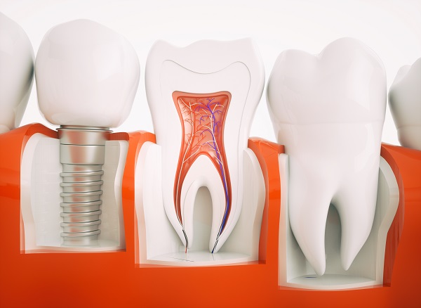 All-on-4 Dental Implants Los Angeles, CA