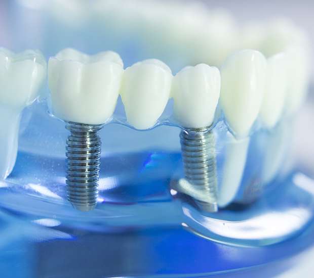 Los Angeles Dental Implants