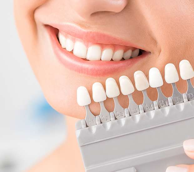 Los Angeles Dental Veneers and Dental Laminates