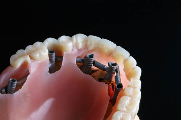 Implant Supported Dentures Los Angeles, CA
