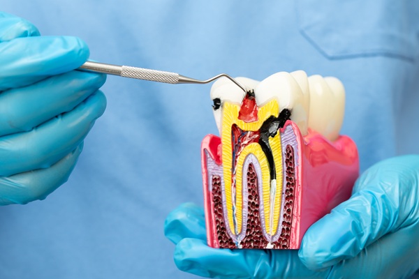 Root Canal Vs  Extraction: Make The Right Choice For Your Oral Health