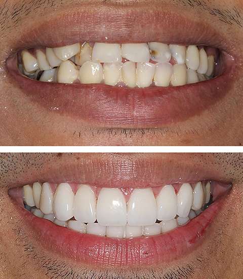 Los Angeles Smile Makeover